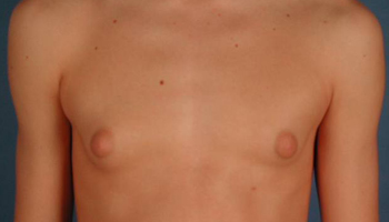 male breast growth